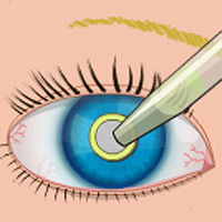 Augenoperation