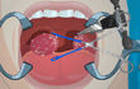 tonsil surgery