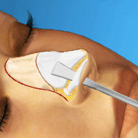 Виртуальная хирургия носа