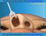 Виртуальная хирургия носа: Nose Surgery
